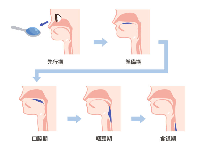 誤嚥の予防策